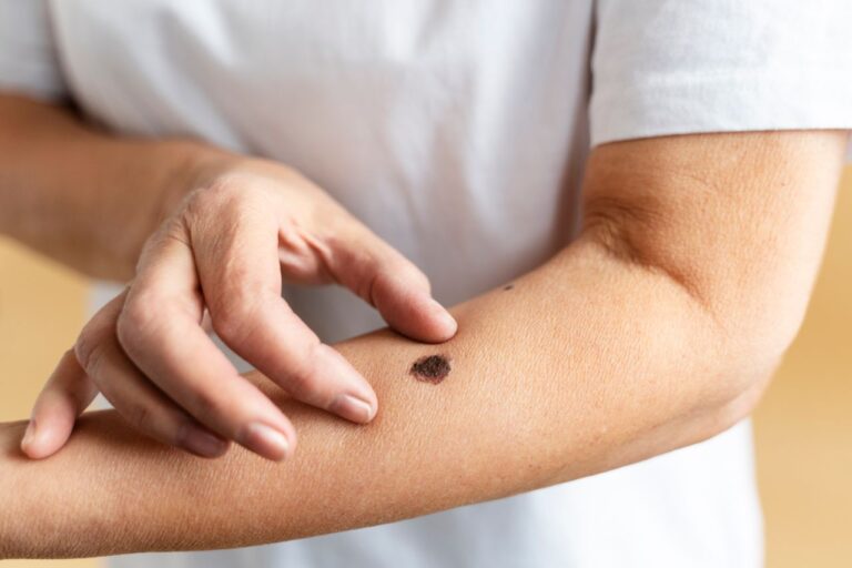 A person pointing at a large, dark mole on their forearm with their other hand, conducting a skin check for potential skin cancer.