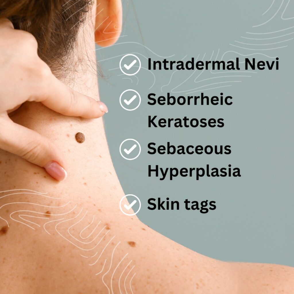 Close-up of a person touching the back of their neck, showcasing different types of skin lesions: intradermal nevi, seborrheic keratoses, sebaceous hyperplasia, and skin tags. This medical image provides valuable insight for doctors and healthcare professionals.