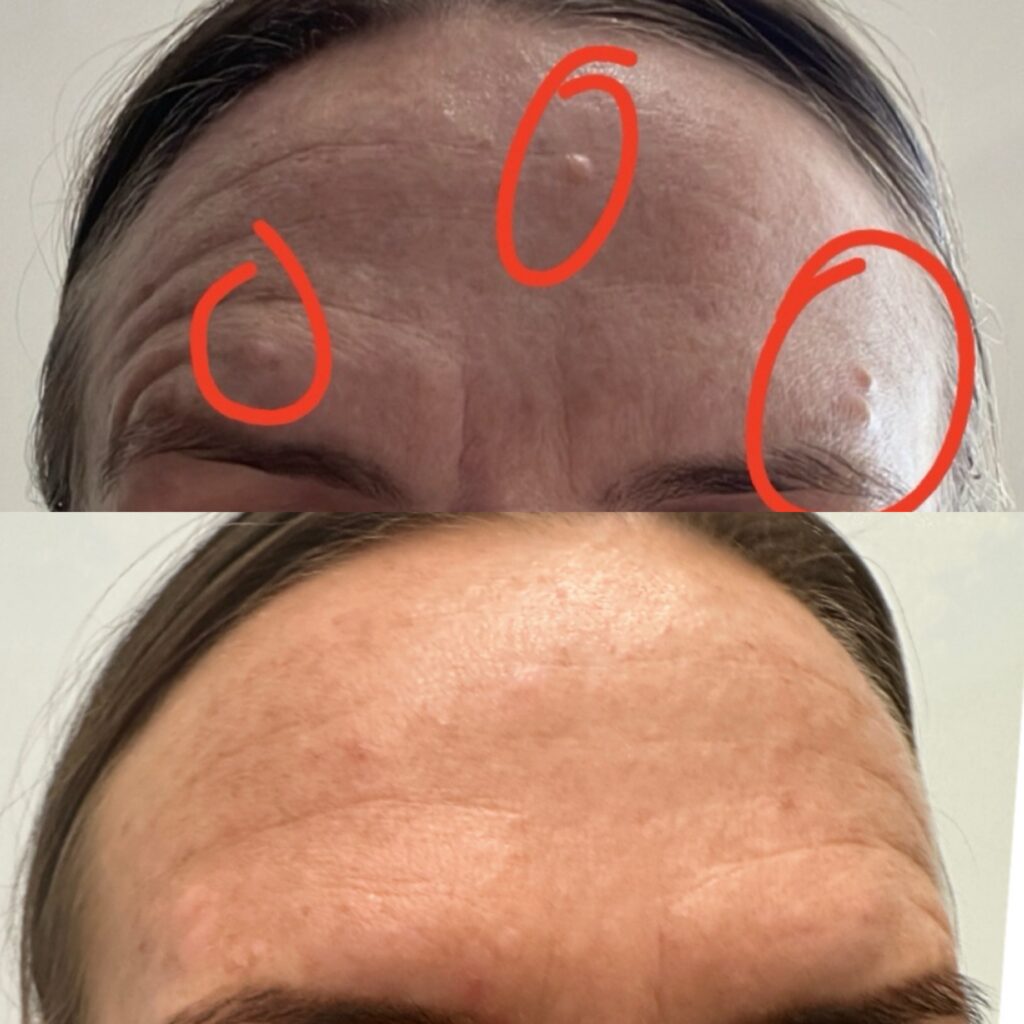 Side-by-side comparison of a forehead showing three red-circled pimples (top) and a smoother forehead with reduced blemishes (bottom).