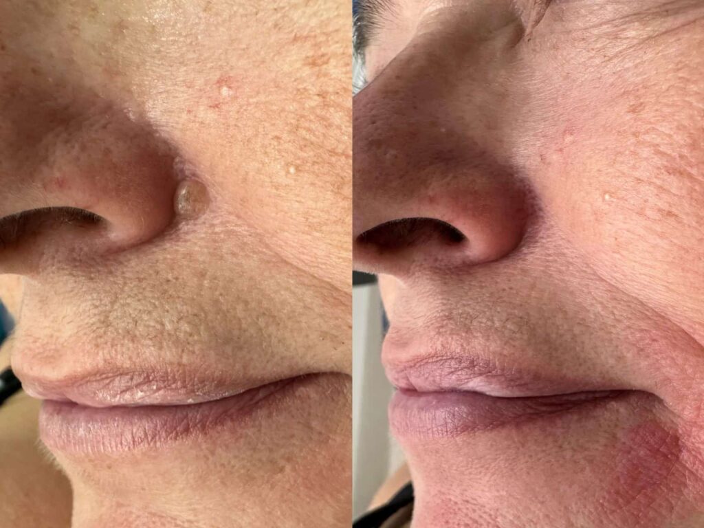 Close-up side-by-side comparison of a person's lower face before (top) and after (bottom) treatment. The skin appears slightly smoother in the 'after' image.