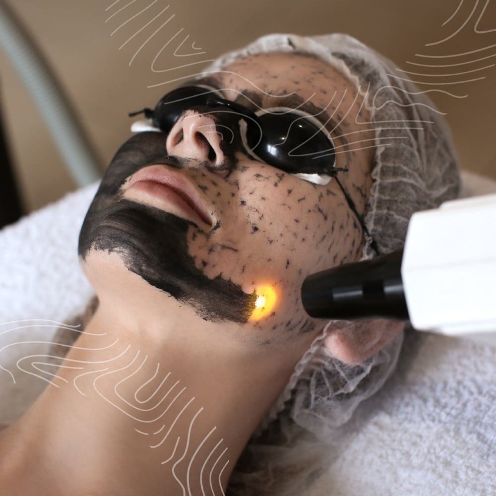 A person undergoing a laser skin treatment with a black mask applied on their face, wearing protective goggles and a hair net.