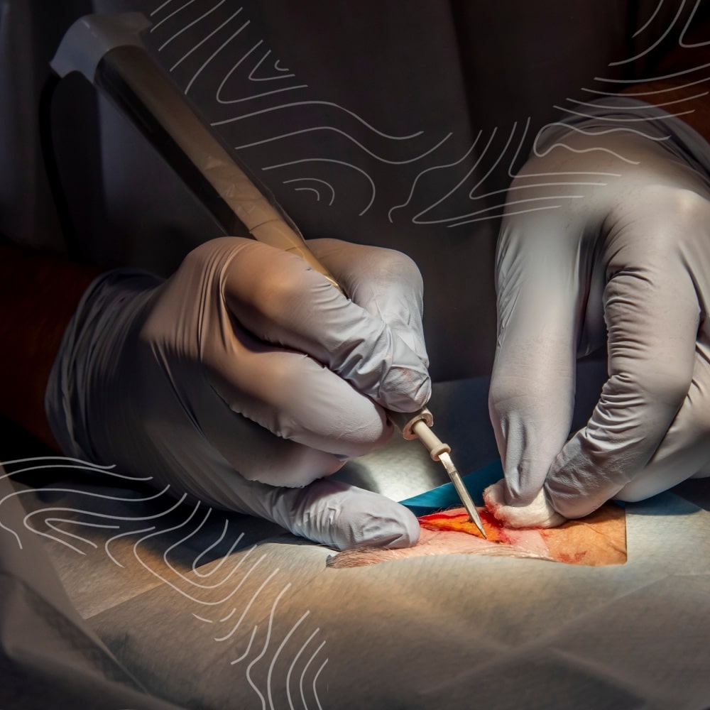 Close-up of gloved hands performing shave and curettage on a patient's skin using surgical tools under a surgical drape, expertly conducting skin checks to ensure thorough cancer checks.