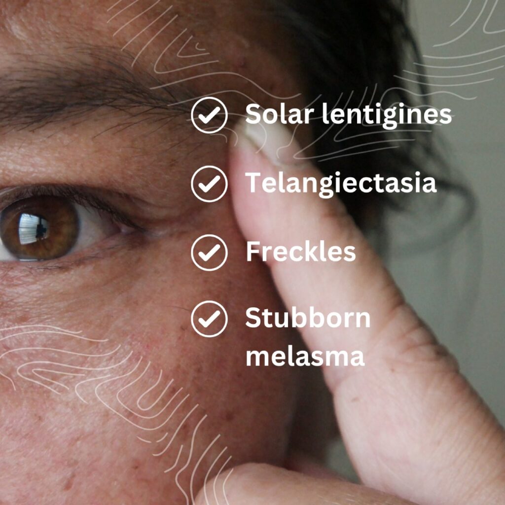 Close-up of a person's face, focusing on skin conditions by the eye with text listing: Solar lentigines, Telangiectasia, Freckles, and Stubborn melasma. Healthcare professionals will note these concerns for targeted attention.