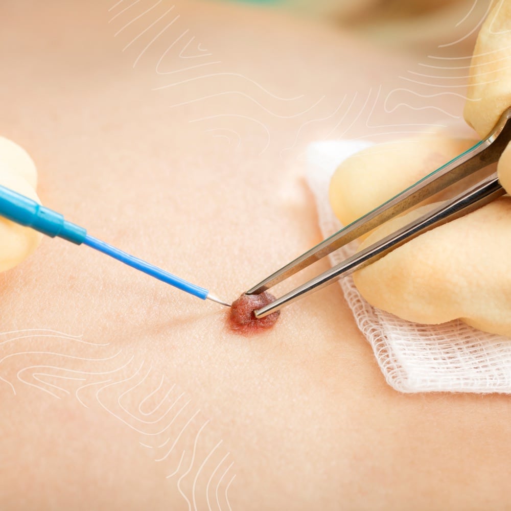 A gloved hand uses tweezers to hold a mole while another gloved hand uses a blue cautery tool to remove it from the skin.