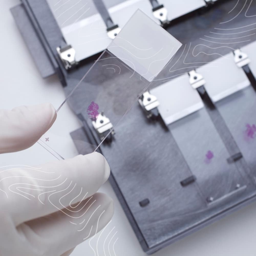 A gloved hand holds a glass microscope slide with a pink-stained sample for skin cancer biopsy.