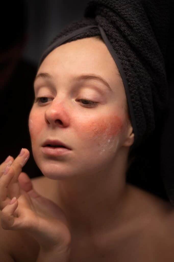 A person with a towel wrapped around their head is applying skincare product to their face, focusing on a red area on their cheek possibly preparing for Photodynamic Therapy.