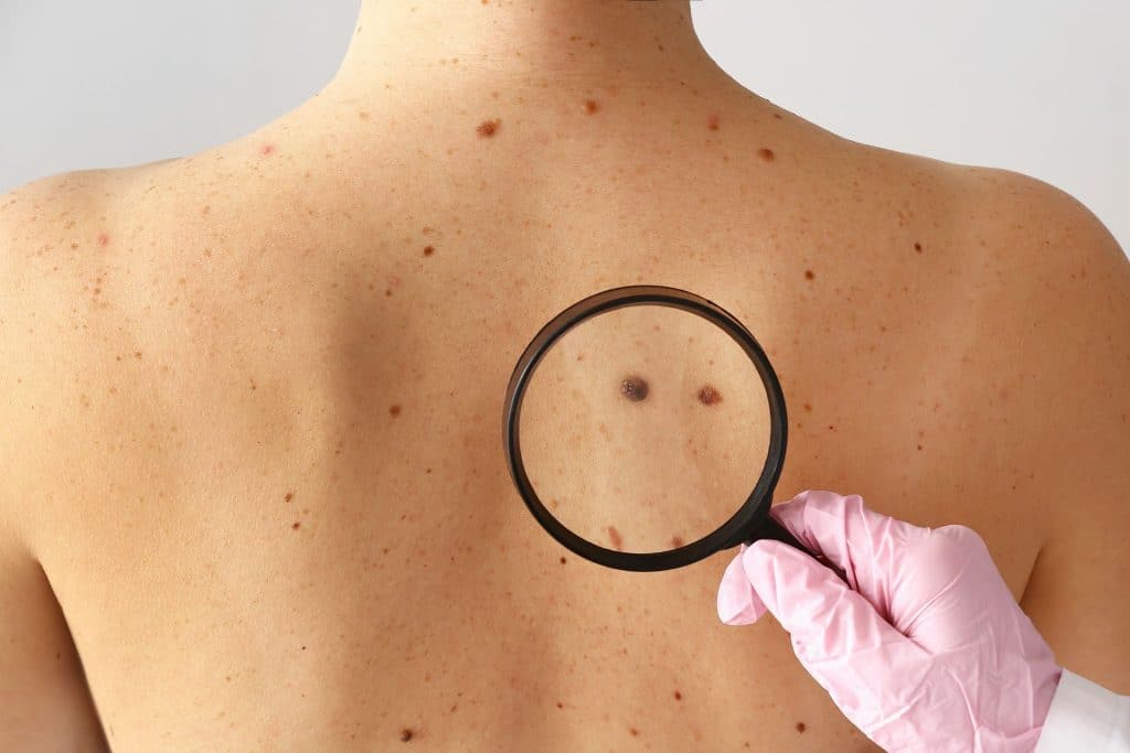 A person with many moles on their back, one being examined with a magnifying glass to spot skin cancer symptoms early.