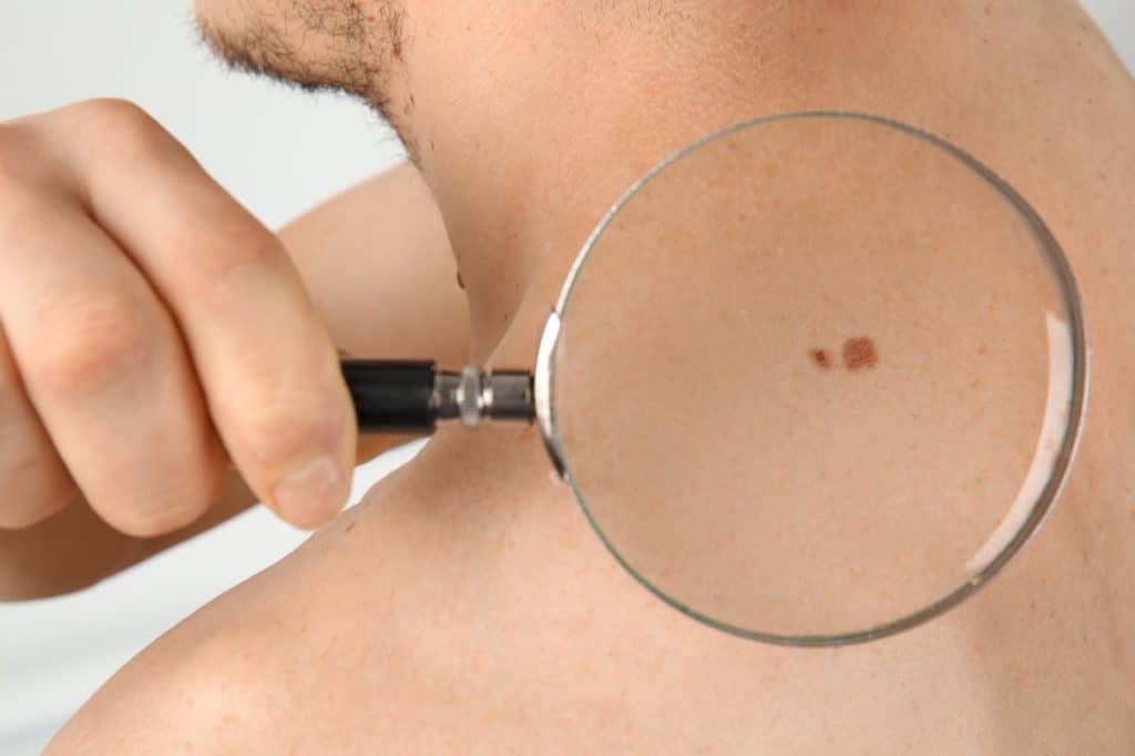 A person holds a magnifying glass to examine a mole or skin lesion on their upper back near the shoulder, highlighting the importance of early detection of skin cancer symptoms.