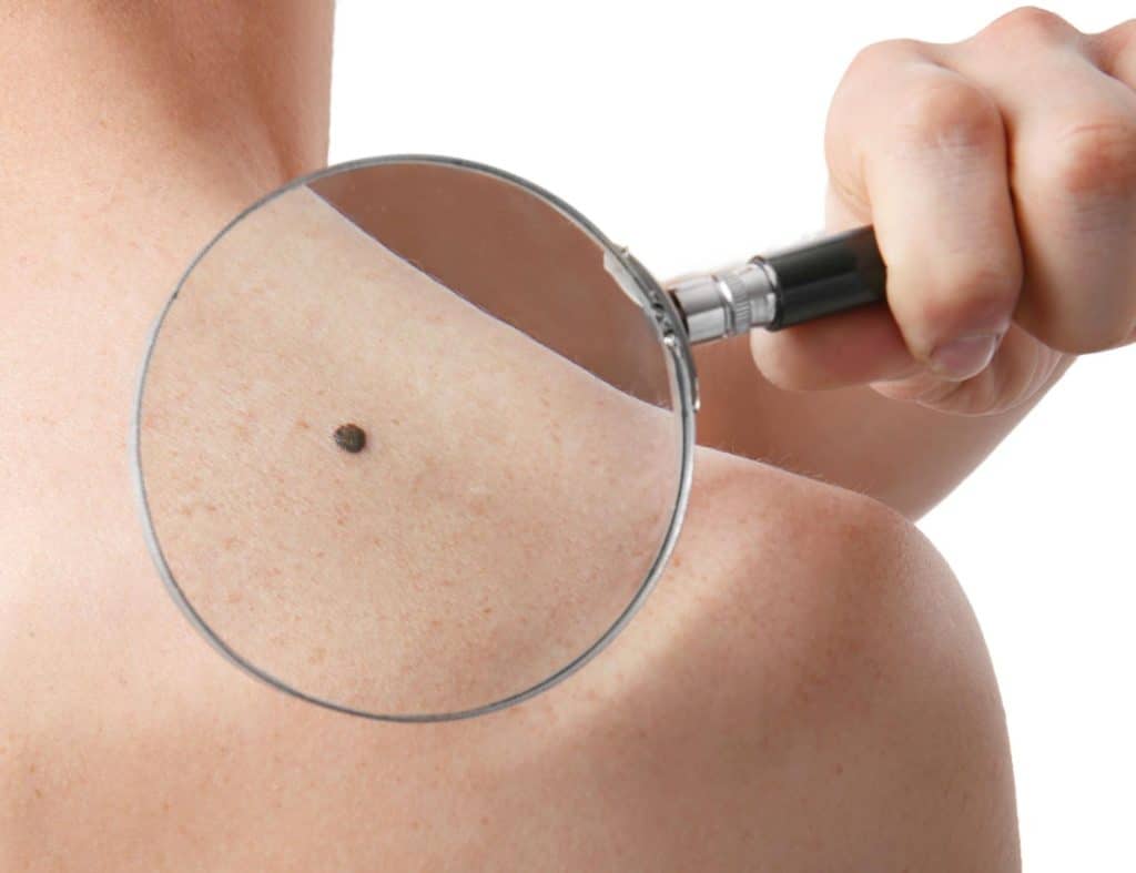 A person holds a magnifying glass over a mole on their shoulder, highlighting the skin detail, to better understand potential causes and assess treatment options for melanoma.