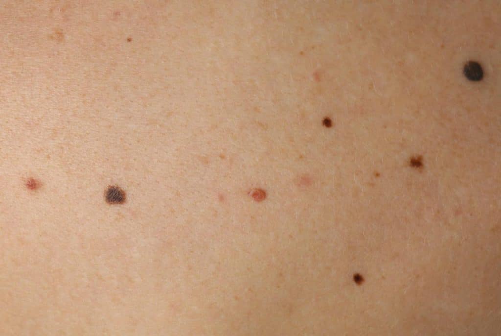 Close-up of human skin showing multiple moles of varying sizes and colors on a light complexion, highlighting features often assessed in a skin cancer clinic for Melanoma risk.