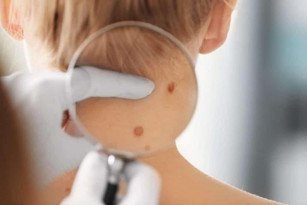 A medical professional at a skin cancer clinic examines moles on the back of a person's neck with a magnifying glass, assessing Melanoma risk.