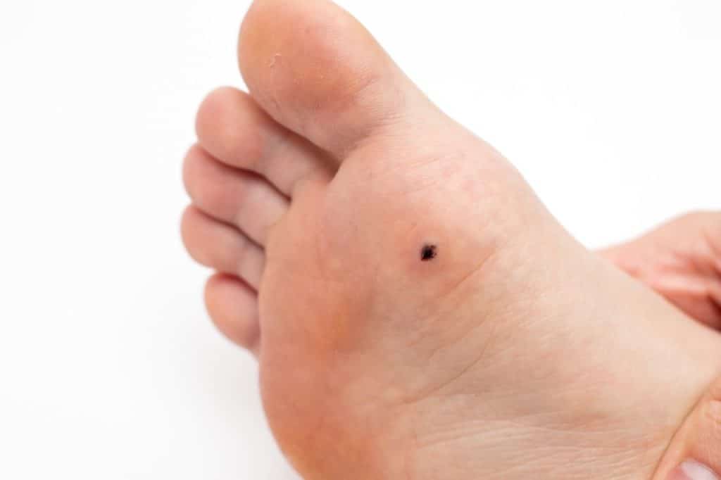 A close-up of the underside of a foot shows a small dark spot or lesion—signs that may raise concerns about melanoma—on the sole near the ball of the foot.