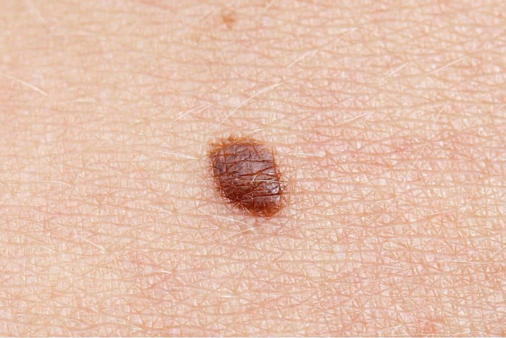 Close-up of a brown mole on human skin, showing skin texture and fine hairs, often examined before treatments like PDT or Fraxel for conditions such as Superficial Basal Cell Carcinoma.