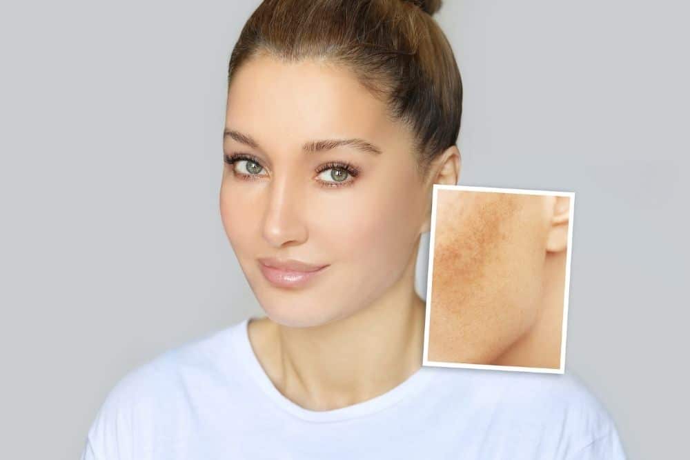 A woman with clear skin is shown; an inset highlights a close-up of skin discoloration or hyperpigmentation on a cheek, illustrating how Fractional Laser Technology can target uneven tone.