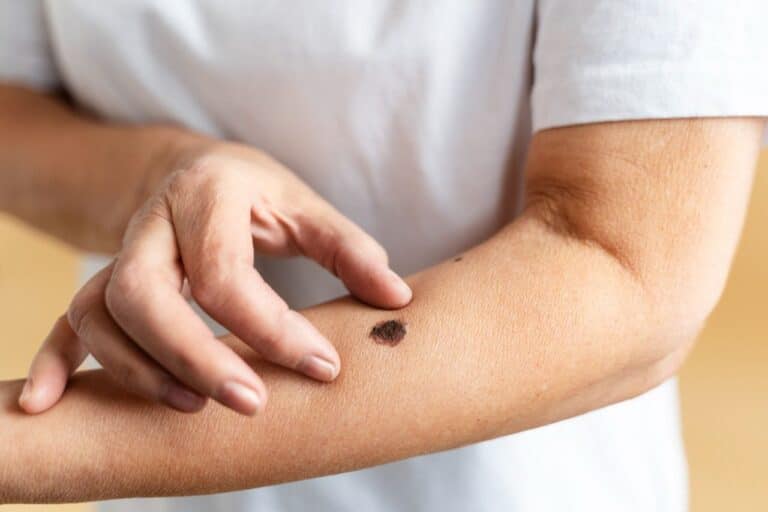 A person touches a large, dark mole on their forearm, inspecting the skin closely as part of their skin cancer prevention routine.