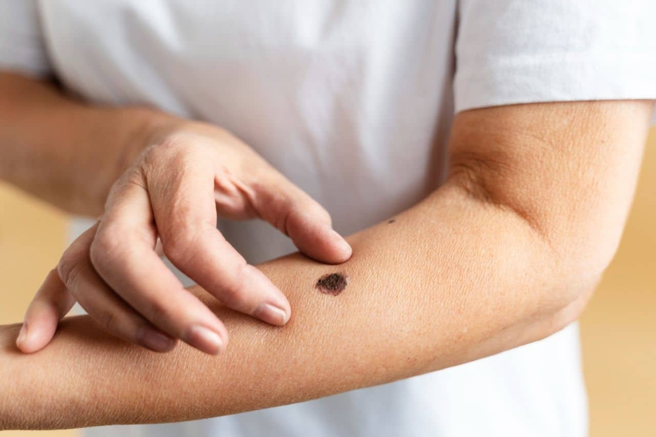 A person touches a large, dark mole on their forearm, inspecting the skin closely as part of their skin cancer prevention routine.
