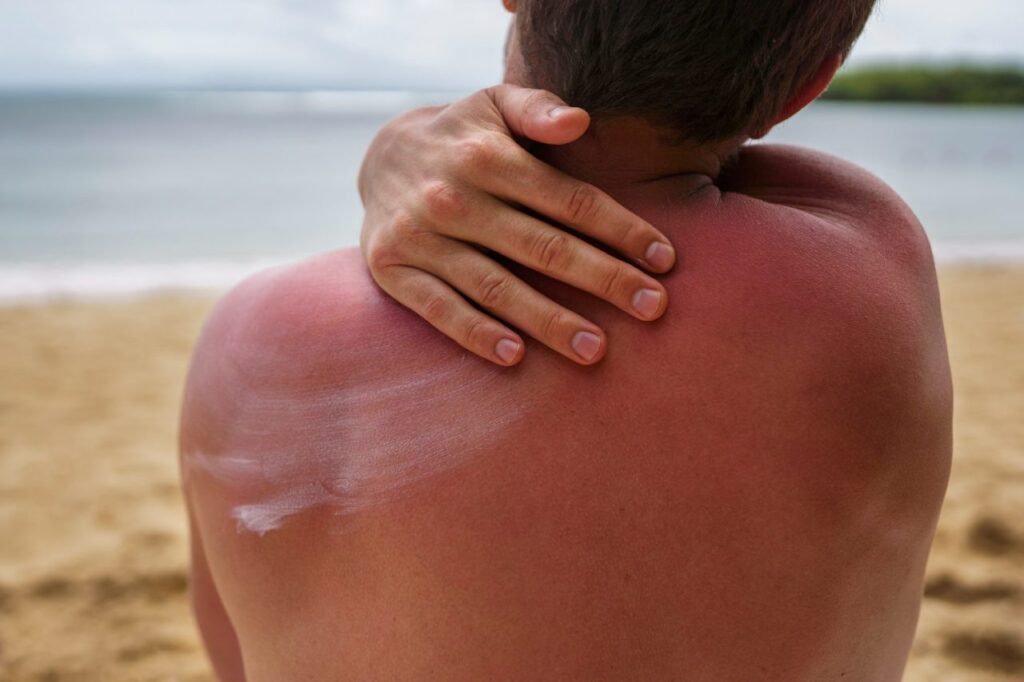 A person with a sunburned back, mindful of the warning sign of Actinic Keratosis, applies sunscreen while sitting on a sandy beach near the water.