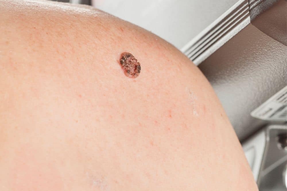 A close-up of a person's skin shows a raised, irregular, dark brown lesion suggestive of Bowen's Disease (Intraepidermal Carcinoma) near medical equipment.